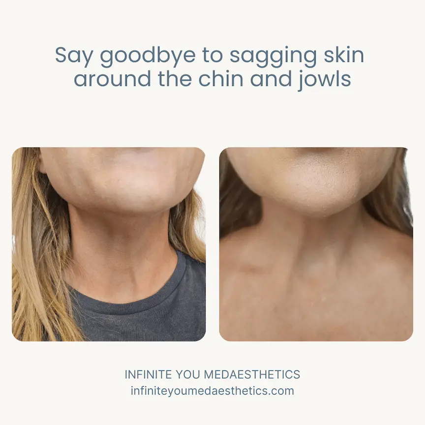 Before and after results of Botox and dermal fillers for chin and jowl tightening at Infinite You MedAesthetics, showing lifted contours, reduced sagging skin, improved jawline definition, smoother skin texture, and natural facial rejuvenation without surgery.