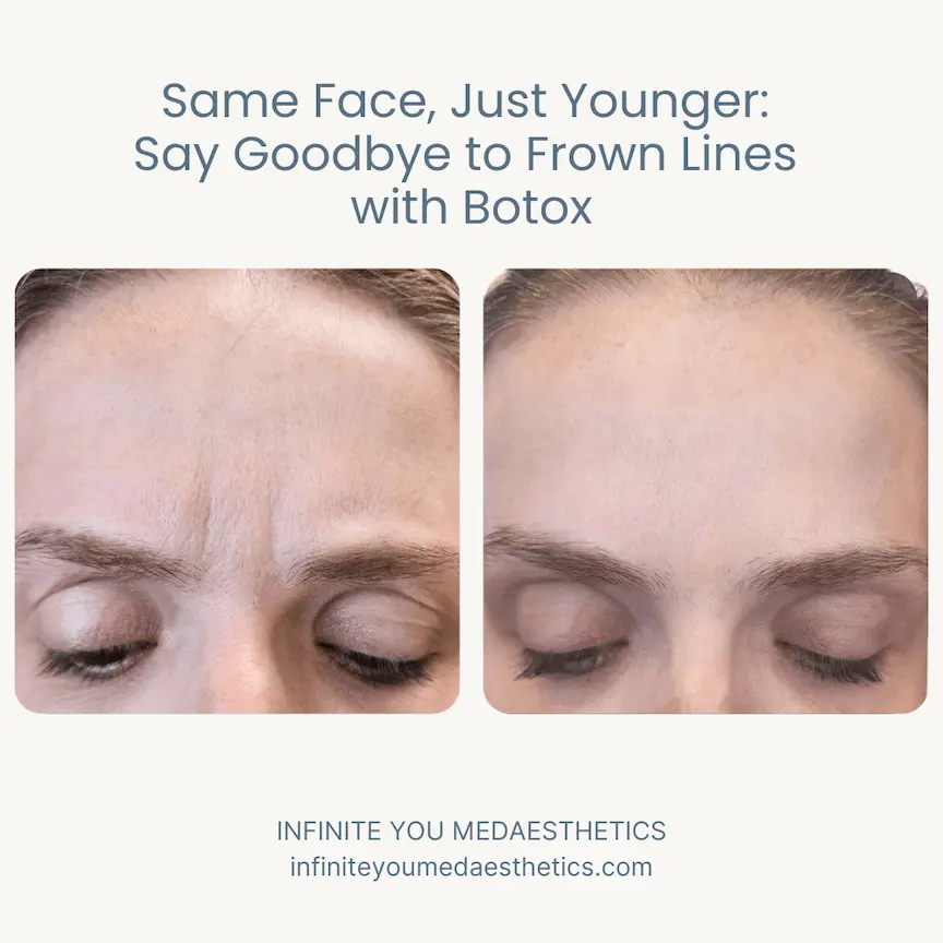 Before and after results of Botox for frown lines at Infinite You MedAesthetics, showing smoother skin between the brows, reduced deep wrinkles and creases, a more relaxed expression, and natural facial rejuvenation without surgery.