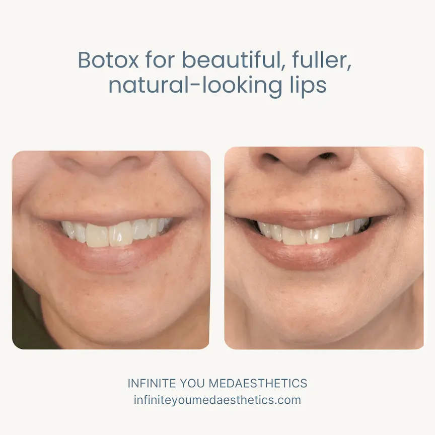 Before and after results of a Botox lip flip at Infinite You MedAesthetics, showing fuller, naturally enhanced lips with improved shape and definition, subtle lift of the upper lip, and a smooth, balanced appearance without fillers.
