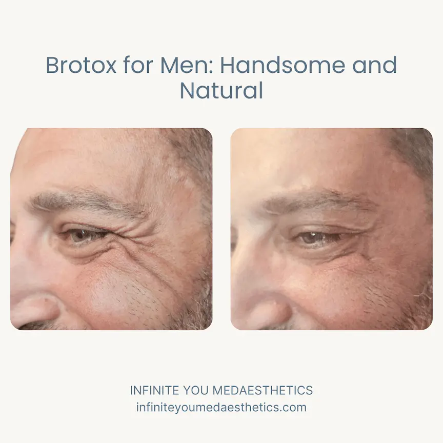 Before and after results of Botox for crow’s feet at Infinite You MedAesthetics, showing a male patient in his 40s with smoother skin around the eyes, reduced fine lines and wrinkles, and a refreshed, natural appearance without looking overdone.