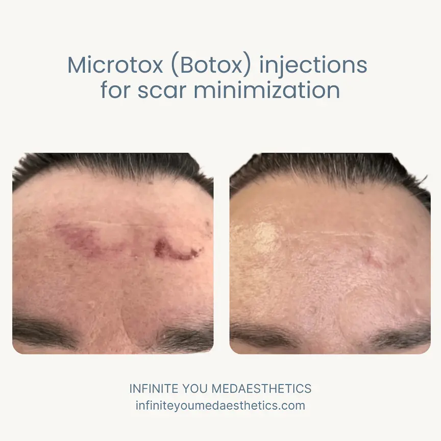 Before and after results of Botox MicroTox scar minimization treatment at Infinite You MedAesthetics, showing smoother skin, softened scar appearance, improved texture, and natural healing support with precise micro-injections.