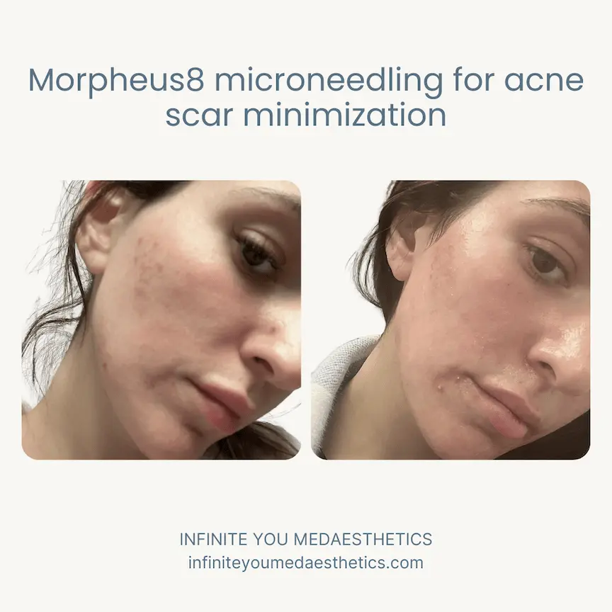 Before and after results of Morpheus8 microneedling treatment for acne scarring at Infinite You MedAesthetics, showing smoother skin texture, reduced acne scars, boosted collagen production, and a clearer, more even complexion.