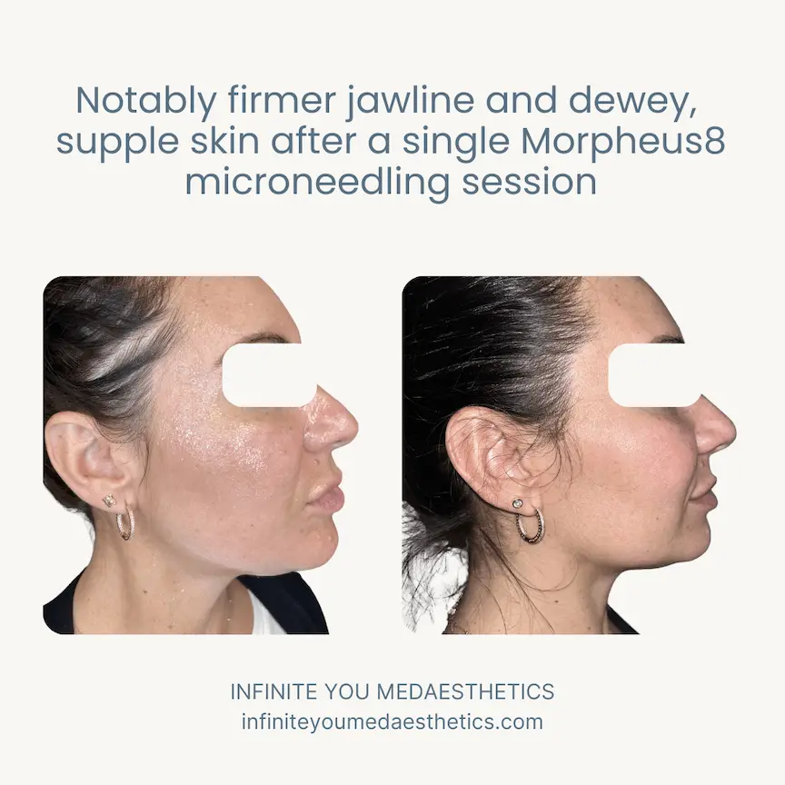 Before and after results of Morpheus8 microneedling for face skin tightening at Infinite You MedAesthetics, showing lifted jowls, smoother jawline definition, reduced fine lines and wrinkles, and a natural non-surgical facelift effect across the whole face.
